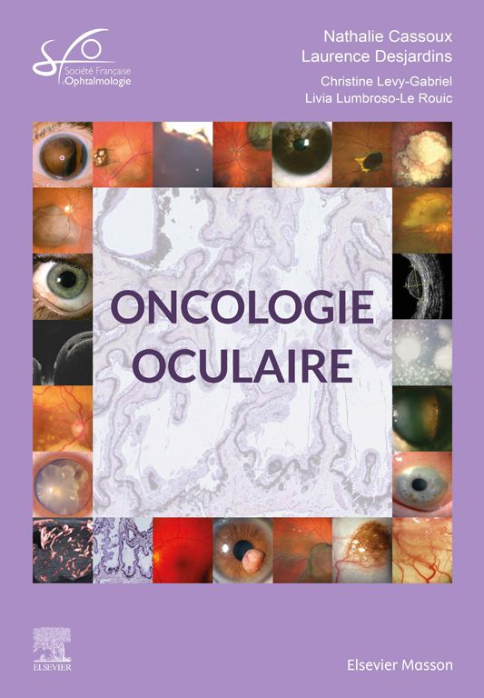 Rapport SFO, Oncologie oculaire