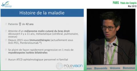 Complication oculaire d’une immunothérapie anti-cancéreuse ? 