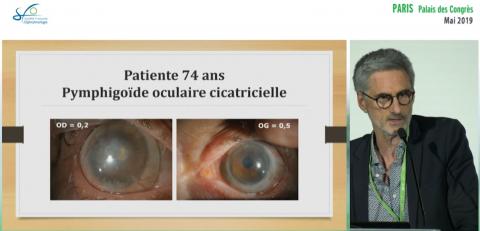 Gérer une cataracte derrière une cornée opaque