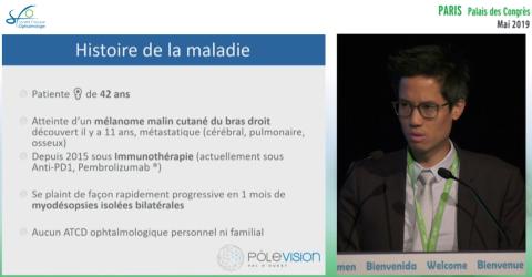 Complication oculaire d’une immunothérapie anti-cancéreuse ? 