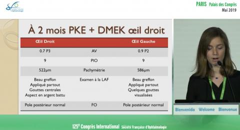 Fuchs récidivant bilatéral après DMEK