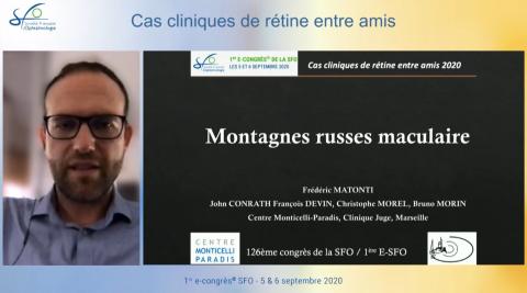 Montagne russe maculaire. Frédéric MATONTI