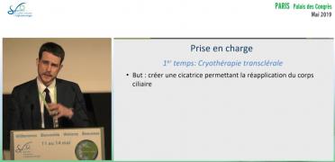 Hypotonie chronique sur cyclodialyse : prise en charge mini-invasive