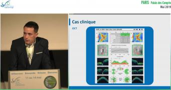 Glaucome: quand plusieurs pressions s’en mêlent... 